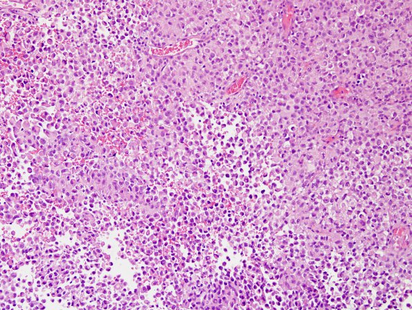 8A1 Meningioma, rhabdoid (Case 8) H&E 21.jpg