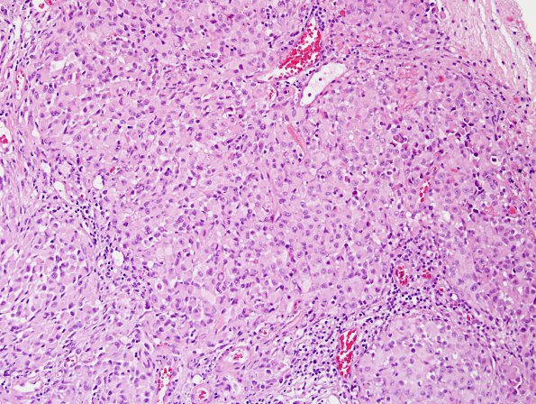 8A2 Meningioma, rhabdoid (Case 8) H&E 4.jpg