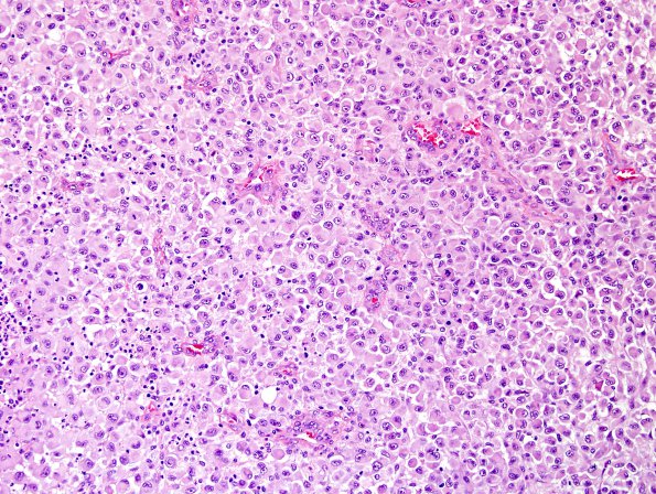 8A3 Meningioma, rhabdoid (Case 8) H&E 15.jpg