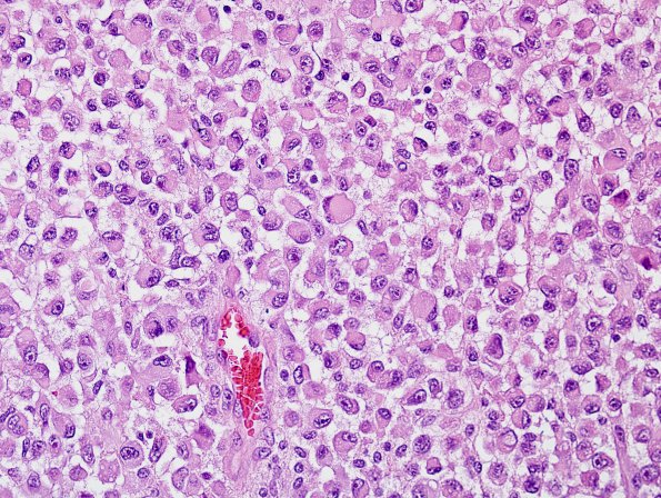 8A4 Meningioma, rhabdoid (Case 8) H&E 20.jpg