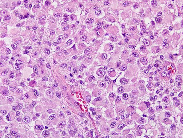 8A6 Meningioma, rhabdoid (Case 8) H&E 19.jpg