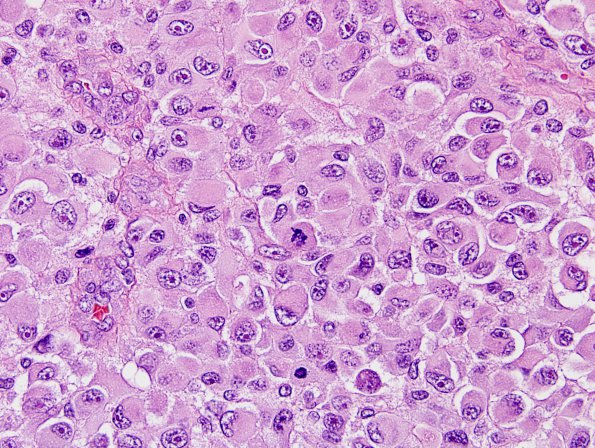 8A7 Meningioma, rhabdoid (Case 8) H&E 17.jpg