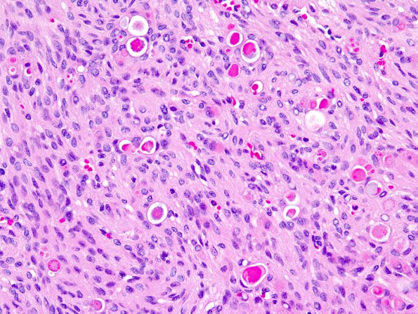 9A1 1Meningioma, secretory (Case 9) 3.jpg