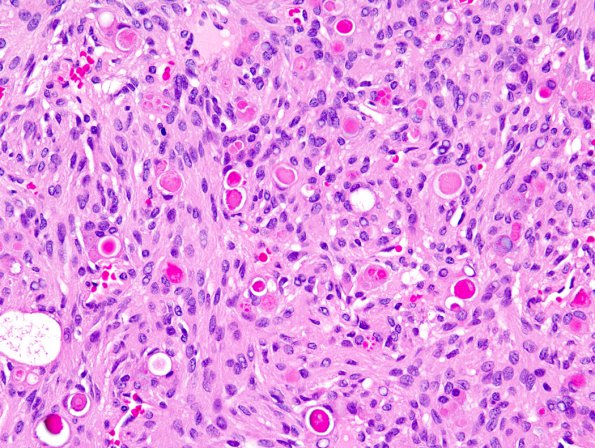 9A2 Meningioma, secretory (Case 9) 1.jpg