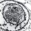 9B1 Meningioma, rhabdoid (Case 9) 13K EM 1 AP Rhab & Sec - Copy