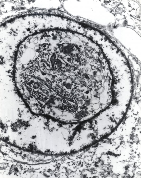 9B1 Meningioma, rhabdoid (Case 9) 13K EM 1 AP Rhab & Sec - Copy