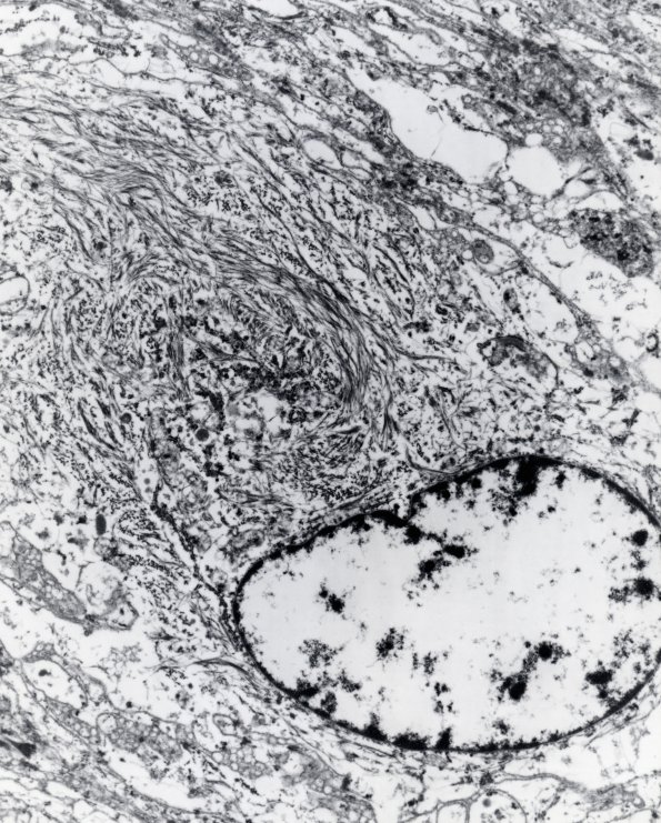 9B2 Meningioma, rhabdoid (Case 9) 13K EM 2 - Copy