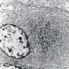 9B3 Meningioma, rhabdoid (Case 9) 13K EM 3 - Copy