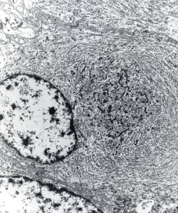 9B3 Meningioma, rhabdoid (Case 9) 13K EM 3 - Copy