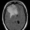 10A1 Meningioma, secretory (Case 10) FLAIR - Copy