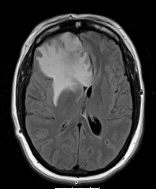 10A1 Meningioma, secretory (Case 10) FLAIR - Copy