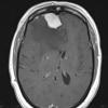 10A2 Meningioma, secretory (Case 10) T1W - Copy