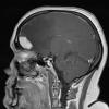 10A3 Meningioma, secretory (Case 10) T1W sagittal - Copy