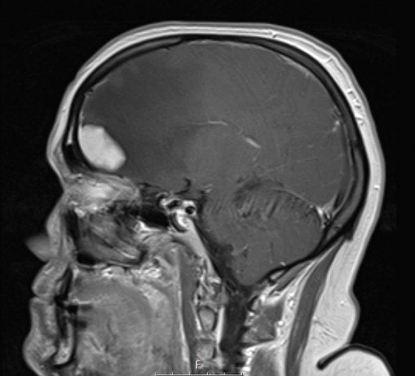 10A3 Meningioma, secretory (Case 10) T1W sagittal - Copy