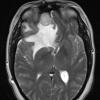 10A4 Meningioma, secretory (Case 10) T2 - Copy