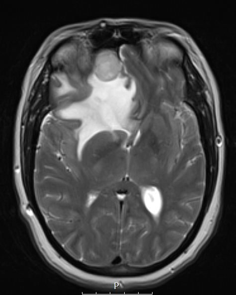 10A4 Meningioma, secretory (Case 10) T2 - Copy