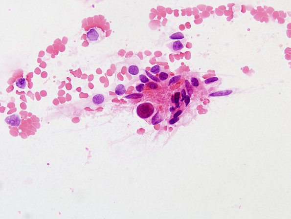 10B1 Meningioma, secretory (Case 10) H&E smear 1.jpg