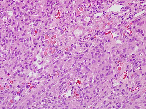 10B2 Meningioma, secretory (Case 10) H&E 3.jpg