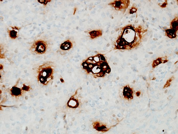 10D3 Meningioma, secretory (Case 10) Poly-CEA 1.jpg