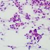 11A1 Meningioma, secretory (Case 11) H&E smear 5.jpg