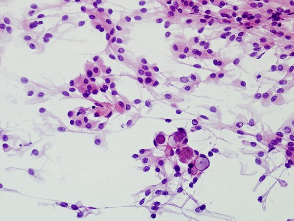 11A1 Meningioma, secretory (Case 11) H&E smear 5.jpg