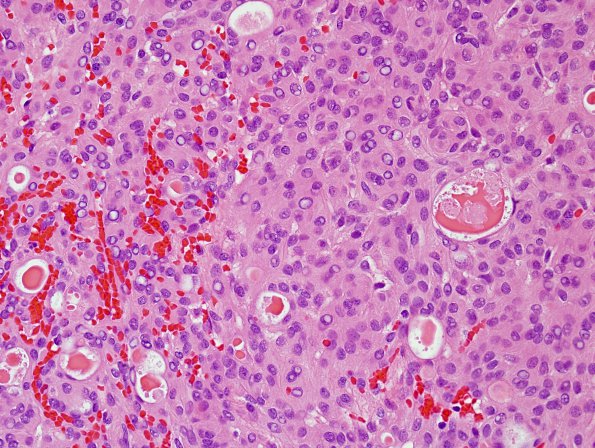 11A3 Meningioma, secretory (Case 11) H&E 4.jpg