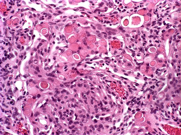 12A Meningioma, secretory variant (Case 12) H&E