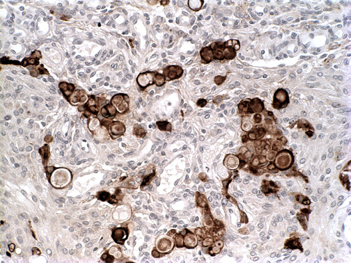 12B Meningioma, secretory variant (Case 12) EMA