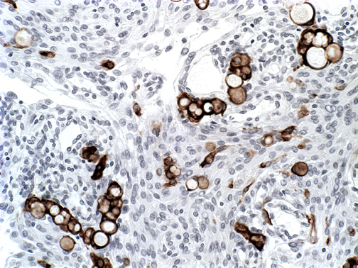 12C Meningioma, secretory variant (Case 12) CK