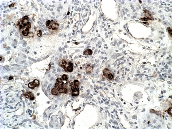 12D Meningioma, secretory variant (Case 12) CEA