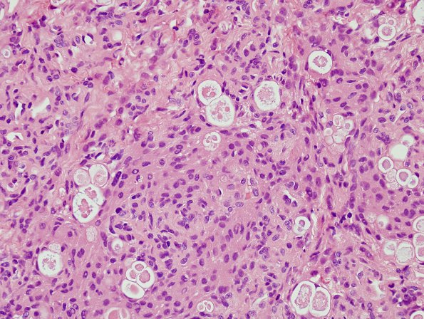 13A1 Meningioma, secretory (Case 13) H&E 1