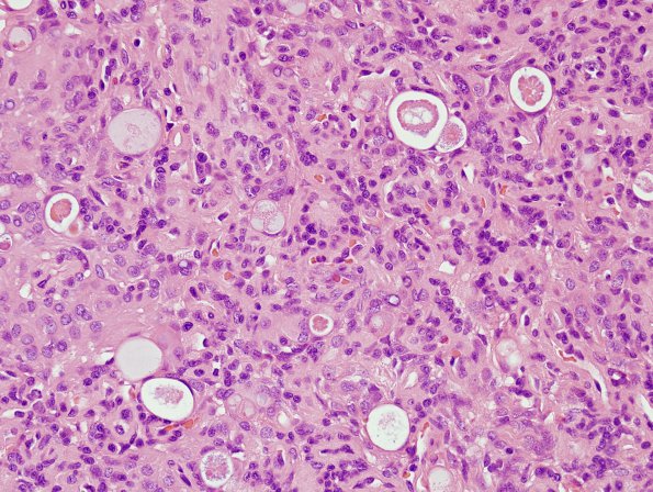 13A2 Meningioma, secretory (Case 13) H&E 3