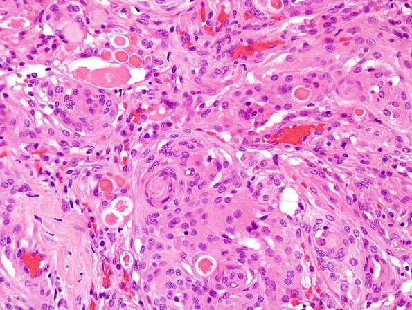 14A1 Meningioma, secretory (Case 14) H&E 3.jpg