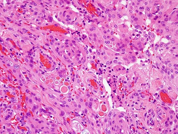 14A2 Meningioma, secretory (Case 14) H&E 4.jpg