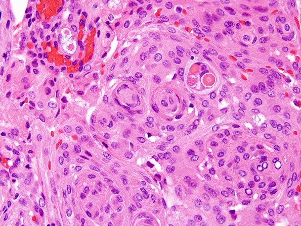 14A3 Meningioma, secretory (Case 14) H&E 5.jpg