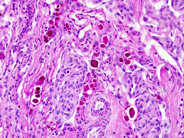 14B Meningioma, secretory (Case 14) PAS with diastase 2.jpg