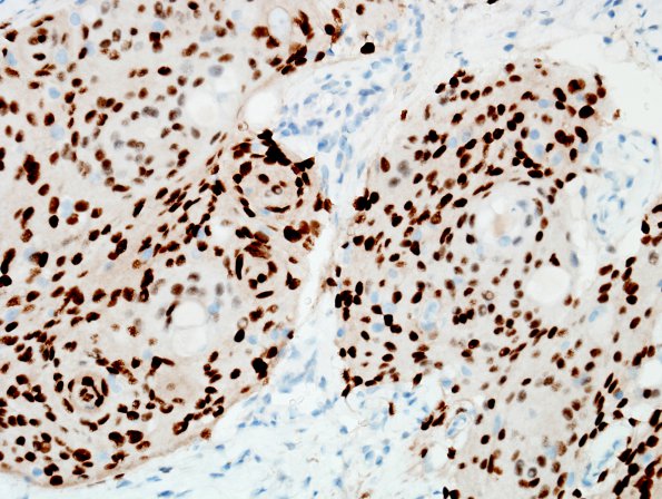 14D Meningioma, secretory (Case 14) PR.jpg