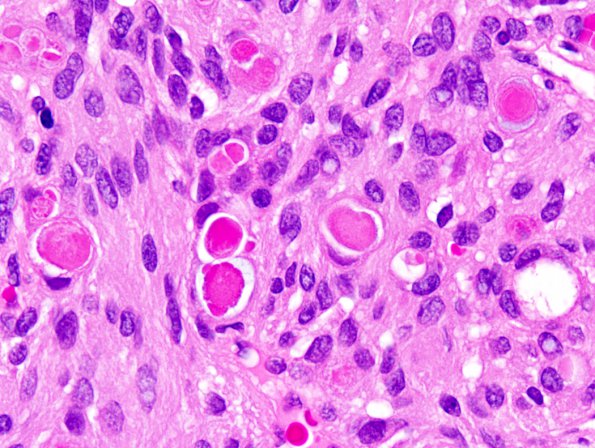 15B2 Meningioma, secretory (Case 15) 2.jpg