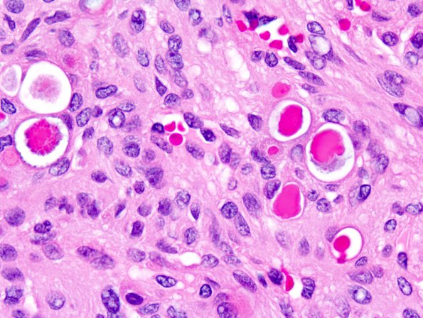 15B4 Meningioma, secretory (Case 15) 4.jpg