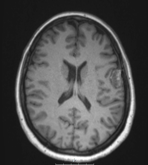 17A2 Meningioma, lipidized (Case 17) T1noC - Copy