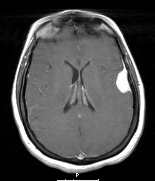 17A3 Meningioma, lipidized (Case 17) T1W - Copy