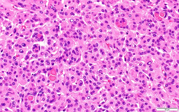 17B1 Meningioma, lipidized (Case 17) 40X 5