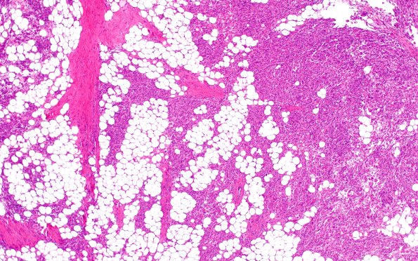 17C1 Meningioma, lipidized (Case 17) 4X