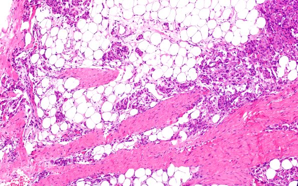 17C2 Meningioma, lipidized (Case 17) 1