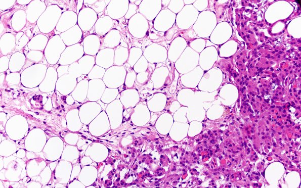 17C3 Meningioma, lipidized (Case 17) 10X