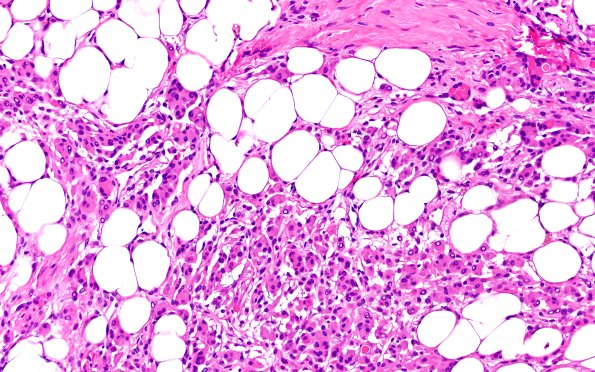 17C4 Meningioma, lipidized (Case 17) 20X