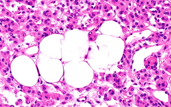 17C5 Meningioma, lipidized (Case 17) 40X 2