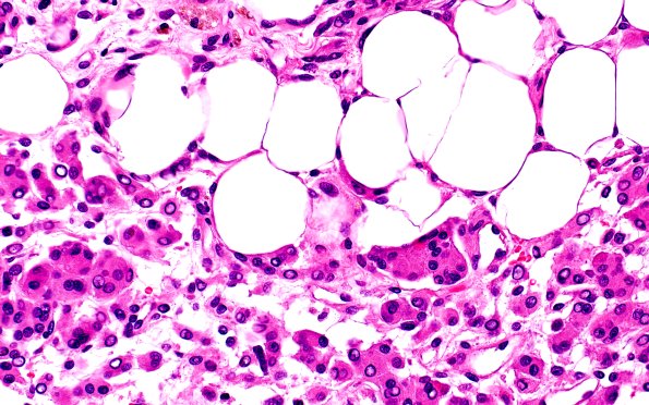 17C6Meningioma, lipidized (Case 17 60X 2