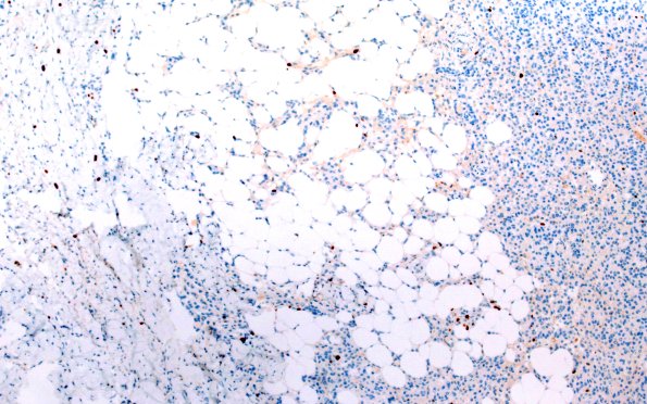 17F1 Meningioma, lipidized (Case 17) Ki67 10X