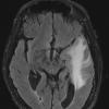 1A1 Meningioma, secretory (Case 1) FLAIR - Copy